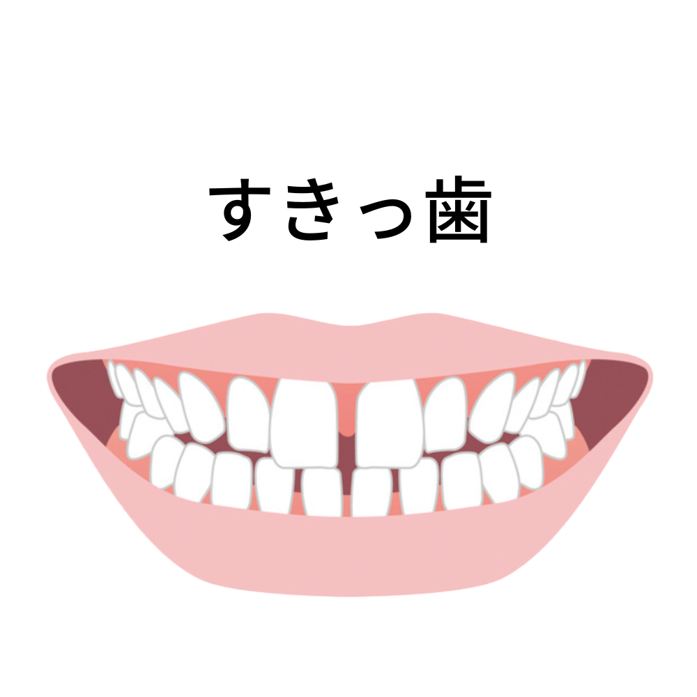 マウスピース矯正は知覚過敏やすきっ歯になるリスク - 芦別矯正歯科相談室