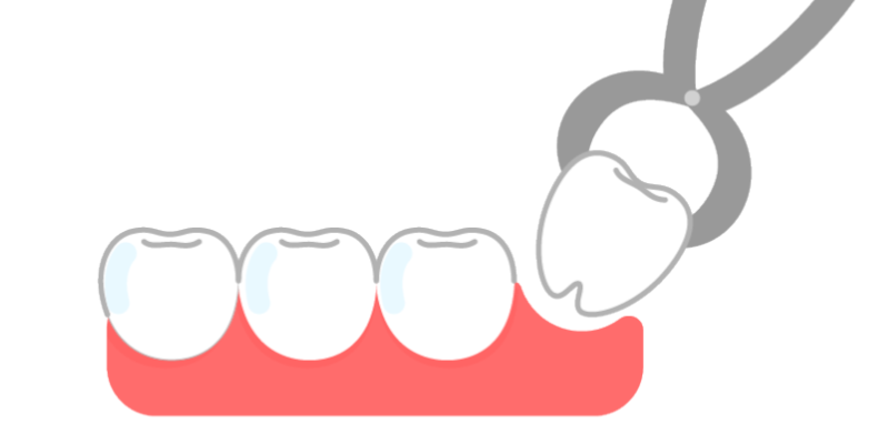 インビザラインは最小限の抜歯で済む - 芦別矯正歯科相談室
