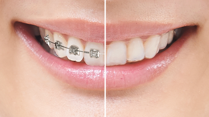 マウスピース矯正は目立たない - 芦別矯正歯科相談室