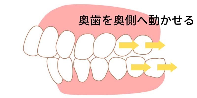 インビザラインは奥歯を動かせる - 芦別矯正歯科相談室