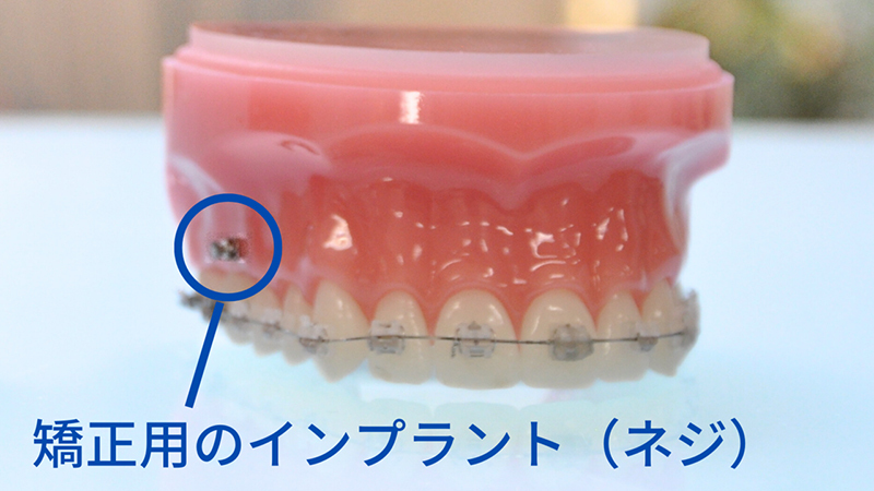 インプラント矯正- 芦別矯正歯科相談室（旭川・富良野・赤平）