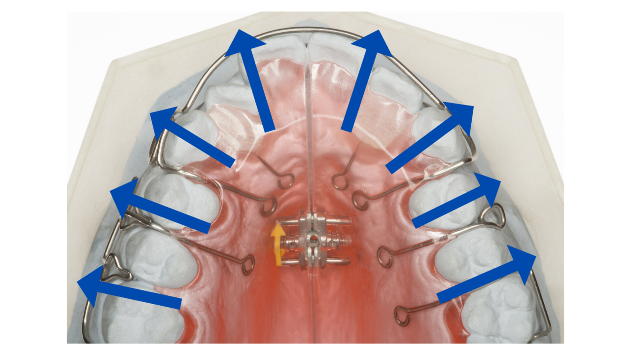 拡大床をつかった矯正-旭川市芦別市 矯正歯科相談室