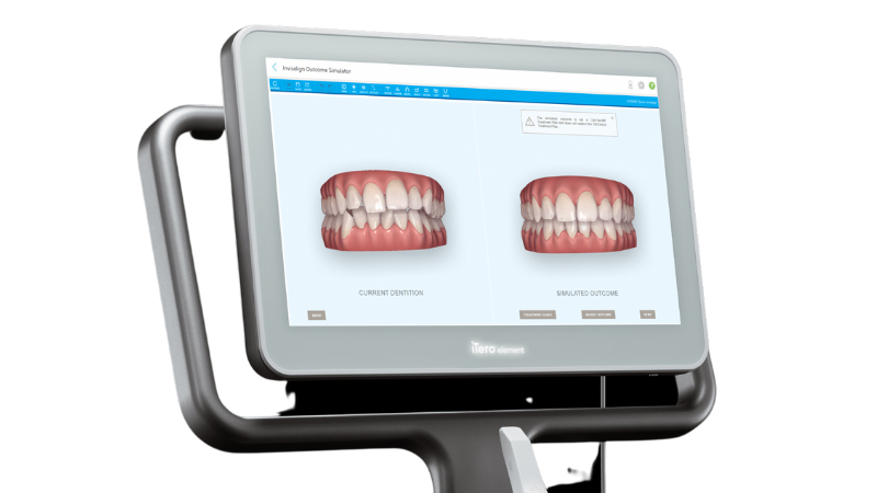 マウスピース矯正は事前に歯並びをシミュレーション - 芦別矯正歯科相談室