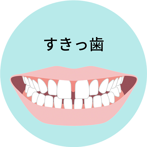すきっ歯- 芦別矯正歯科相談室（旭川・富良野・赤平）