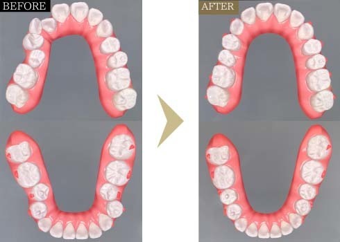 20代女性出っ歯・ガタガタ- 芦別矯正歯科相談室（旭川・富良野・赤平）