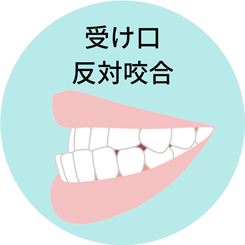 受け口・反対咬合- 芦別矯正歯科相談室（旭川・富良野・赤平）