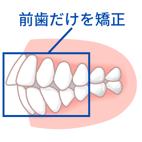前歯だけを動かす矯正で失敗 - 芦別矯正歯科相談室
