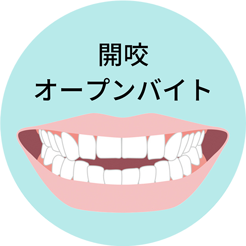 開咬・オープンバイト- 芦別矯正歯科相談室（旭川・富良野・赤平）