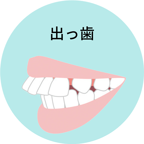 出っ歯- 芦別矯正歯科相談室（旭川・富良野・赤平）