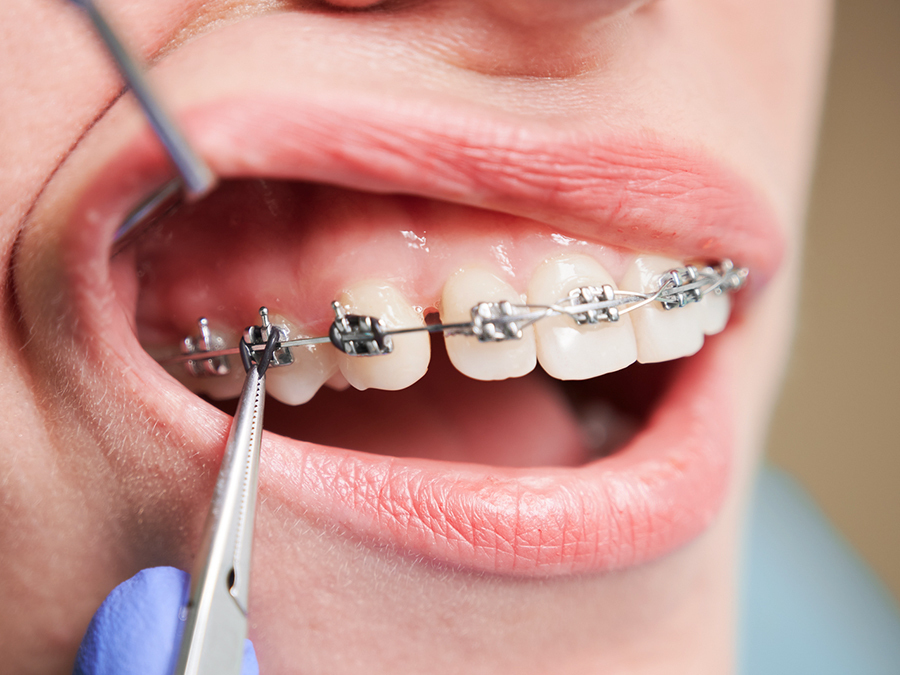 従来のワイヤー矯正 - 芦別矯正歯科相談室