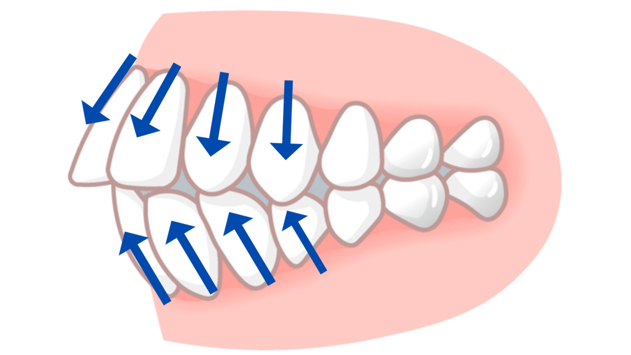 歯を抜かない矯正-旭川市芦別市 矯正歯科相談室