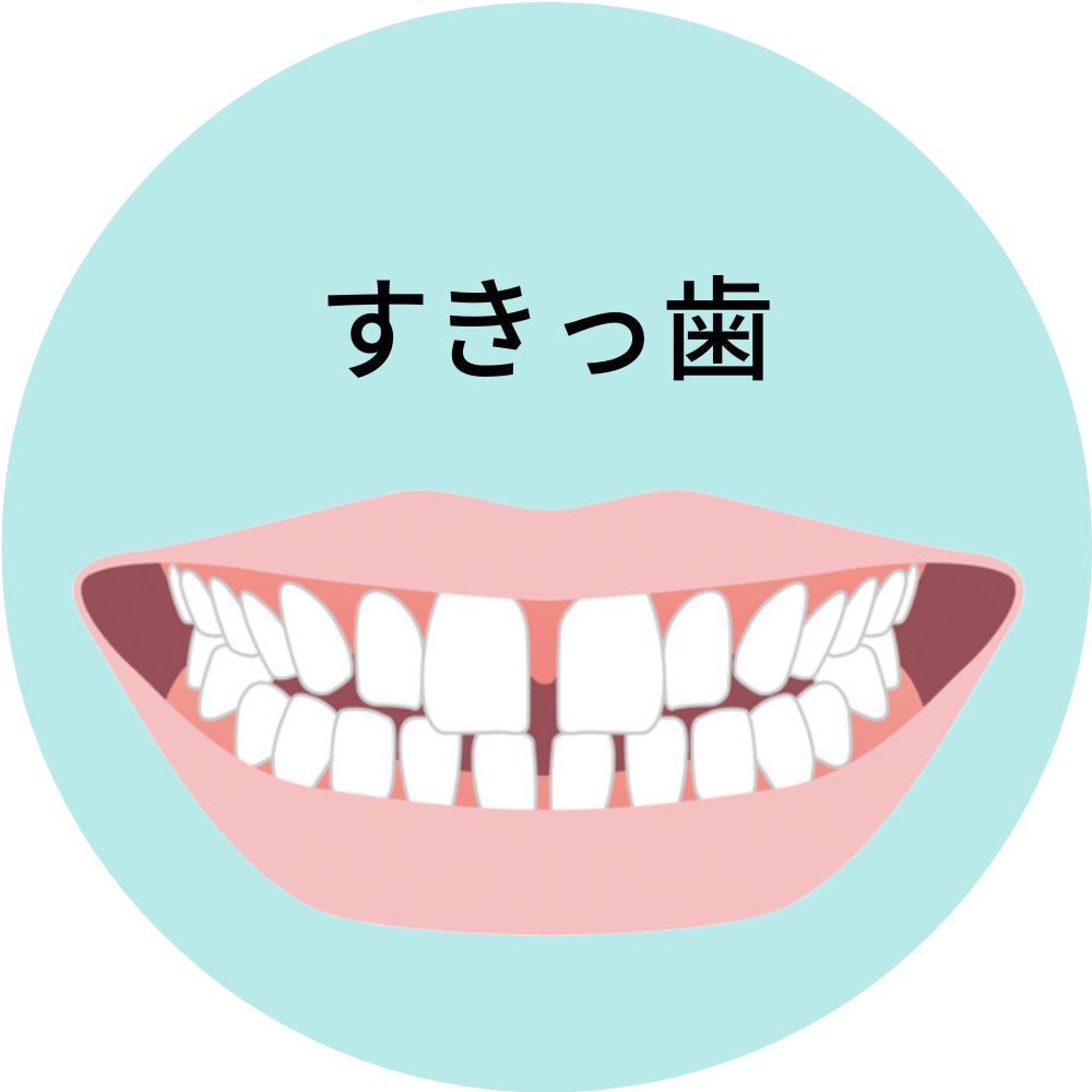 すきっ歯- 芦別矯正歯科相談室（旭川・富良野・赤平）