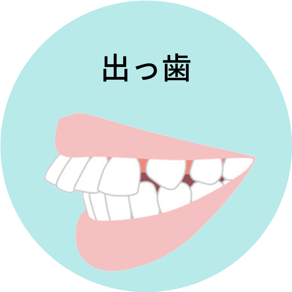 出っ歯- 芦別矯正歯科相談室（旭川・富良野・赤平）
