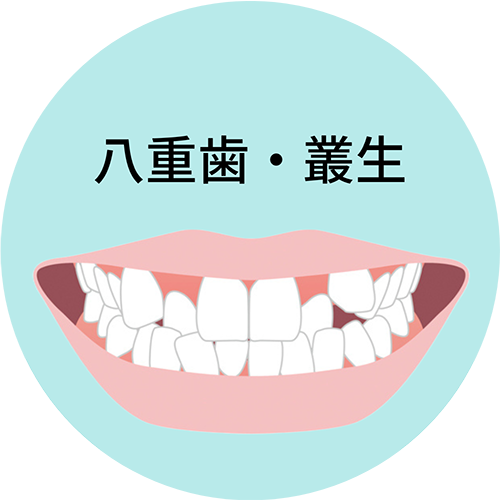 八重歯・叢生- 芦別矯正歯科相談室（旭川・富良野・赤平）
