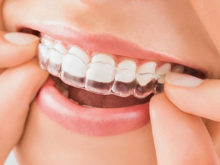 透明で目立たないマウスピース矯正 - 芦別矯正歯科相談室