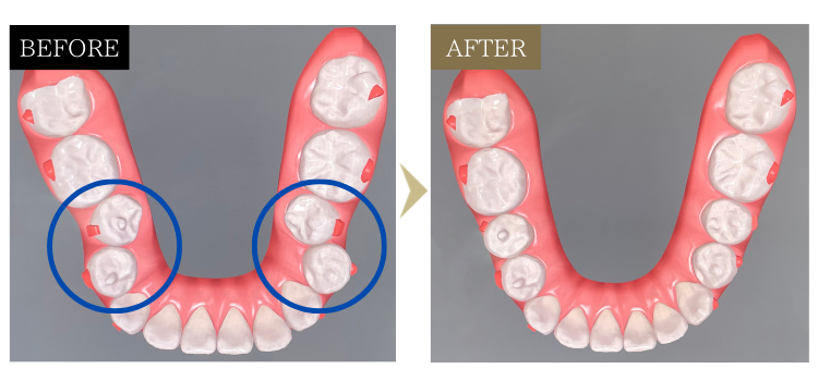 治療後-下の歯並び- 芦別矯正歯科相談室（旭川・富良野・赤平）